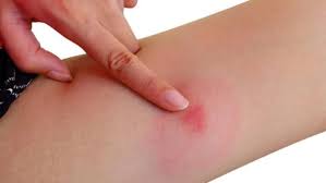 hiperemik deri rengi, hiperemik