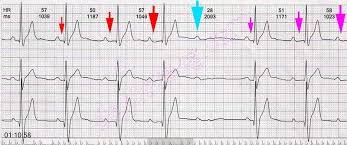 2. İkinci Derece Tip-1 AV Blok